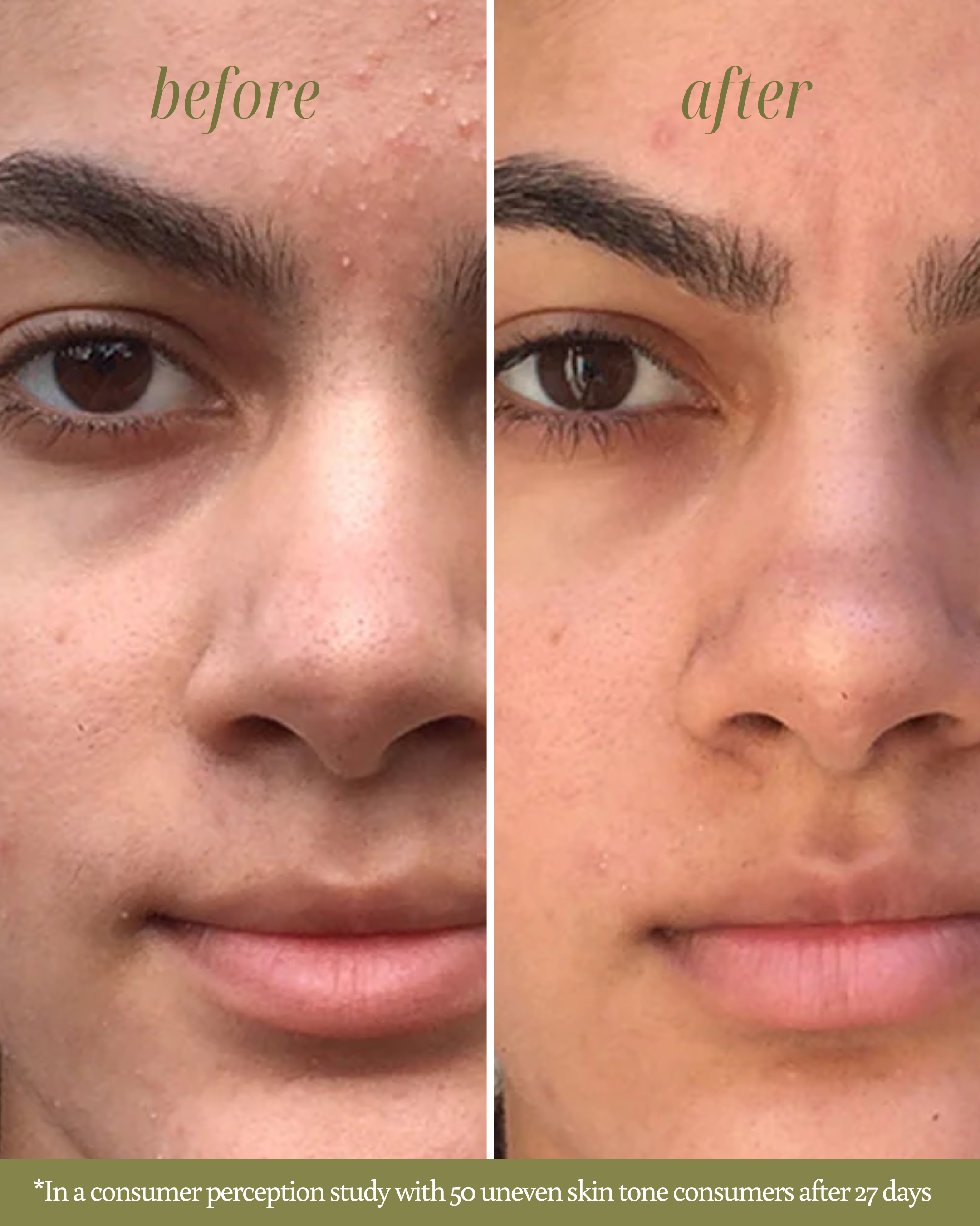 Before and after comparison of skin texture on a person's face. "Before" is labeled on a oily, dull skin, and "After" is labelled on a glowing and hydrated skin