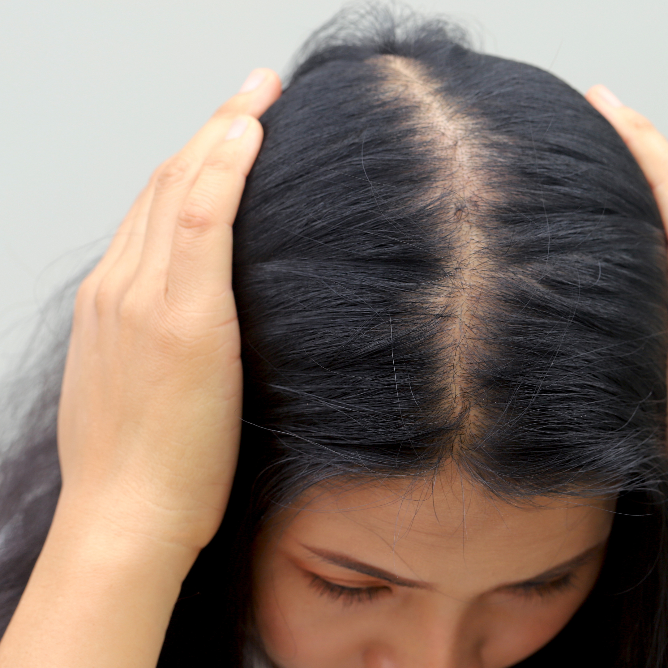 Understanding Hair Thinning and Alopecia in Canada: Causes, Prevention, and Natural Solutions