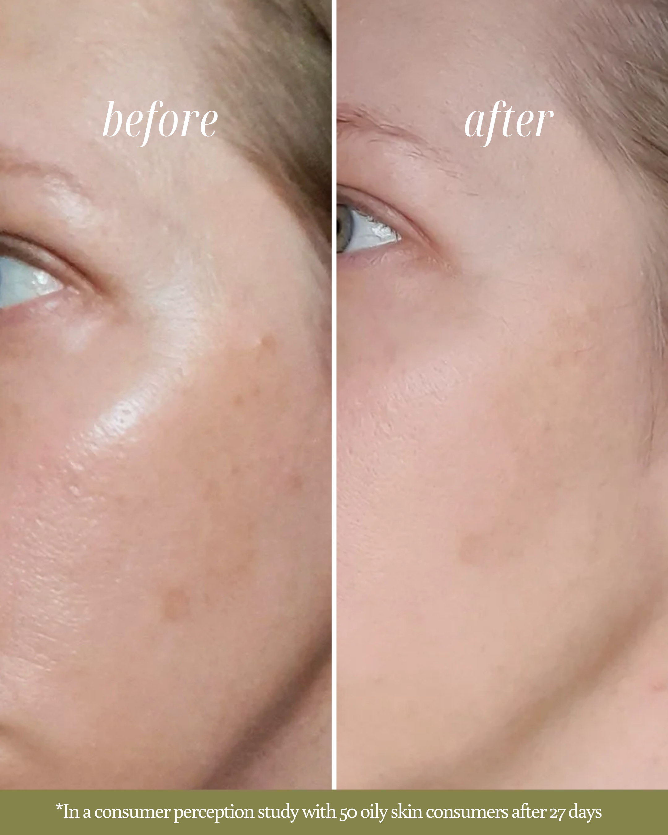 Before and after comparison of skin with a focus on a blemish, labeled 'before' and clear skin labeled 'after'