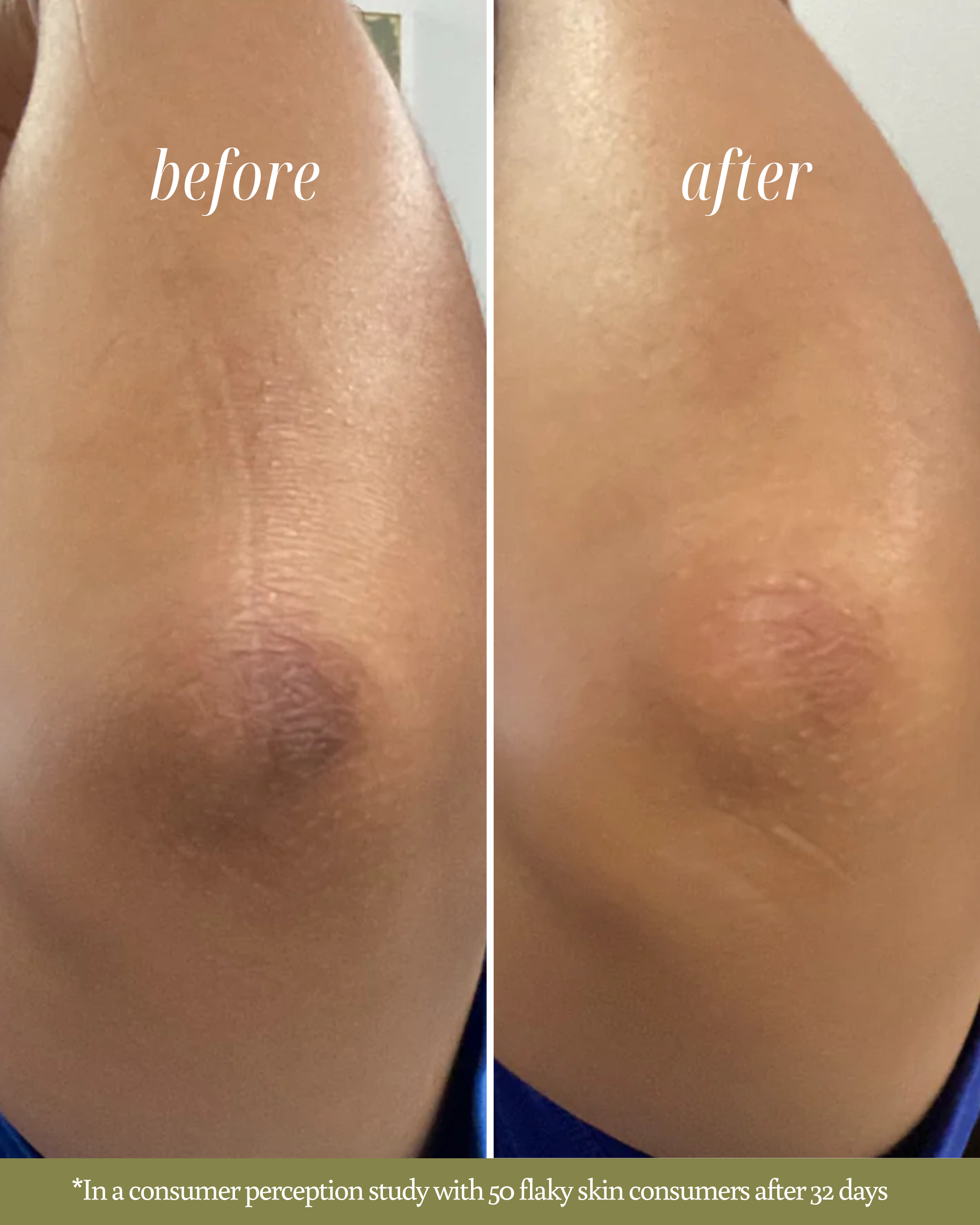 Before and after comparison of skin texture on a person's arm after using soap by Nature's Circle Care with text "in a consumer perception study with 50 flaky skin consumers after 32 days"