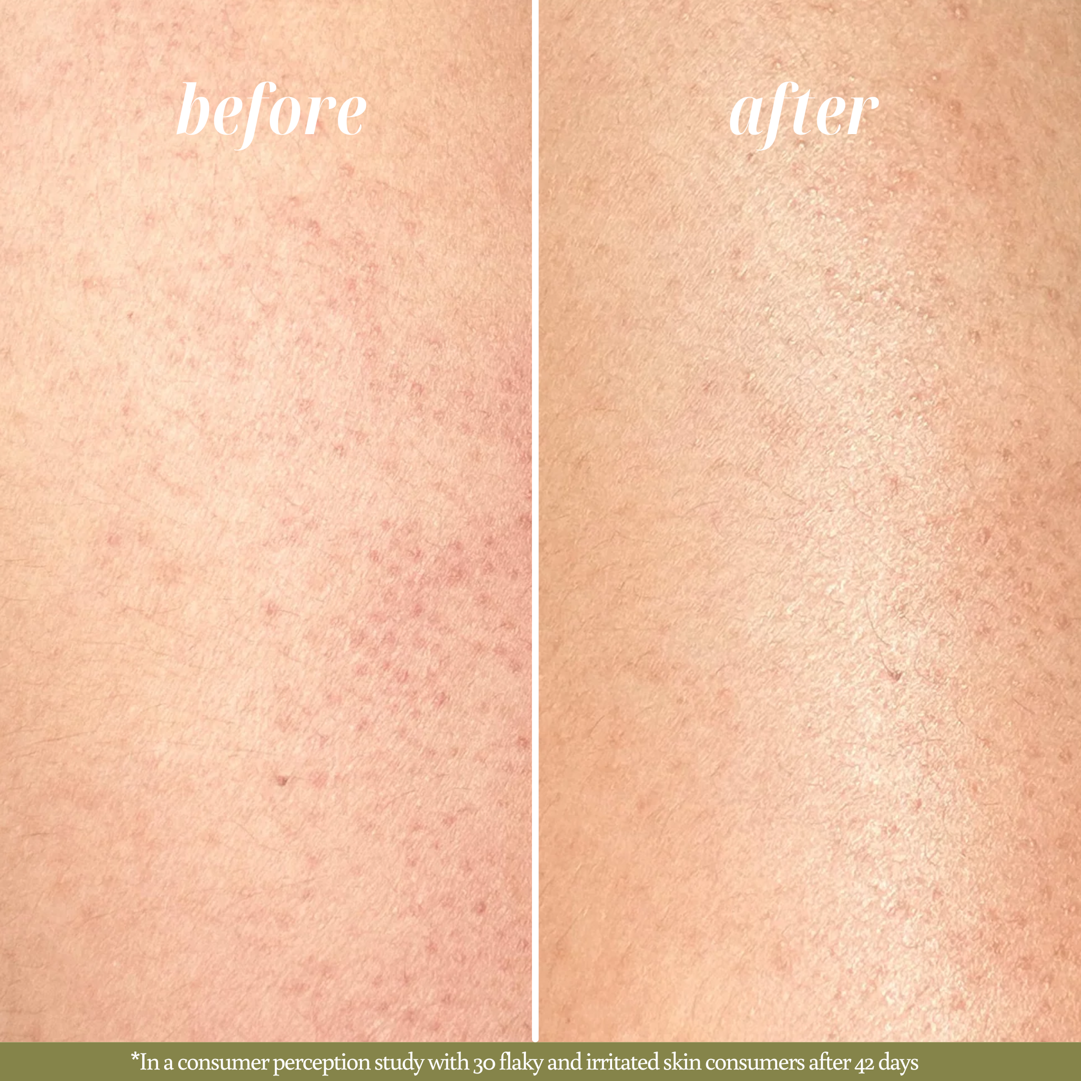 Before and after images showcasing the results of Nature's Circle Care Body Oil. The 'Before' image shows skin with noticeable dryness and redness. The 'After' image reveals visibly healthier moisturized, glowing, and less irritated skin. 94% of participants in a consumer perception study with 50 extremely dry skin individuals agreed that the oil deeply nourished skin and left it feeling comfortable.