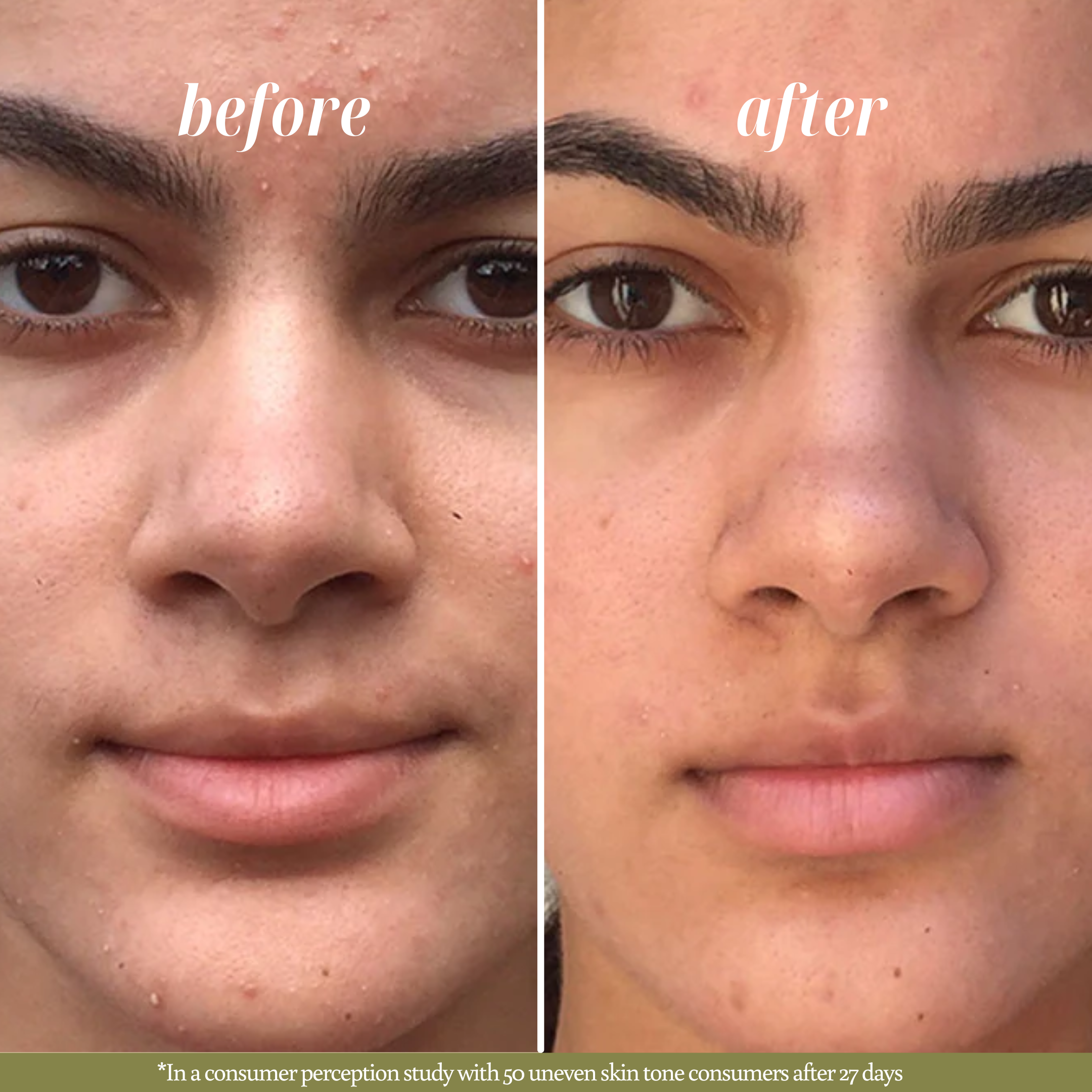 Before and after comparison of skin texture on a person's face. "Before" is labeled on a oily, dull skin, and "After" is labelled on a glowing and hydrated skin after using face clay mask.