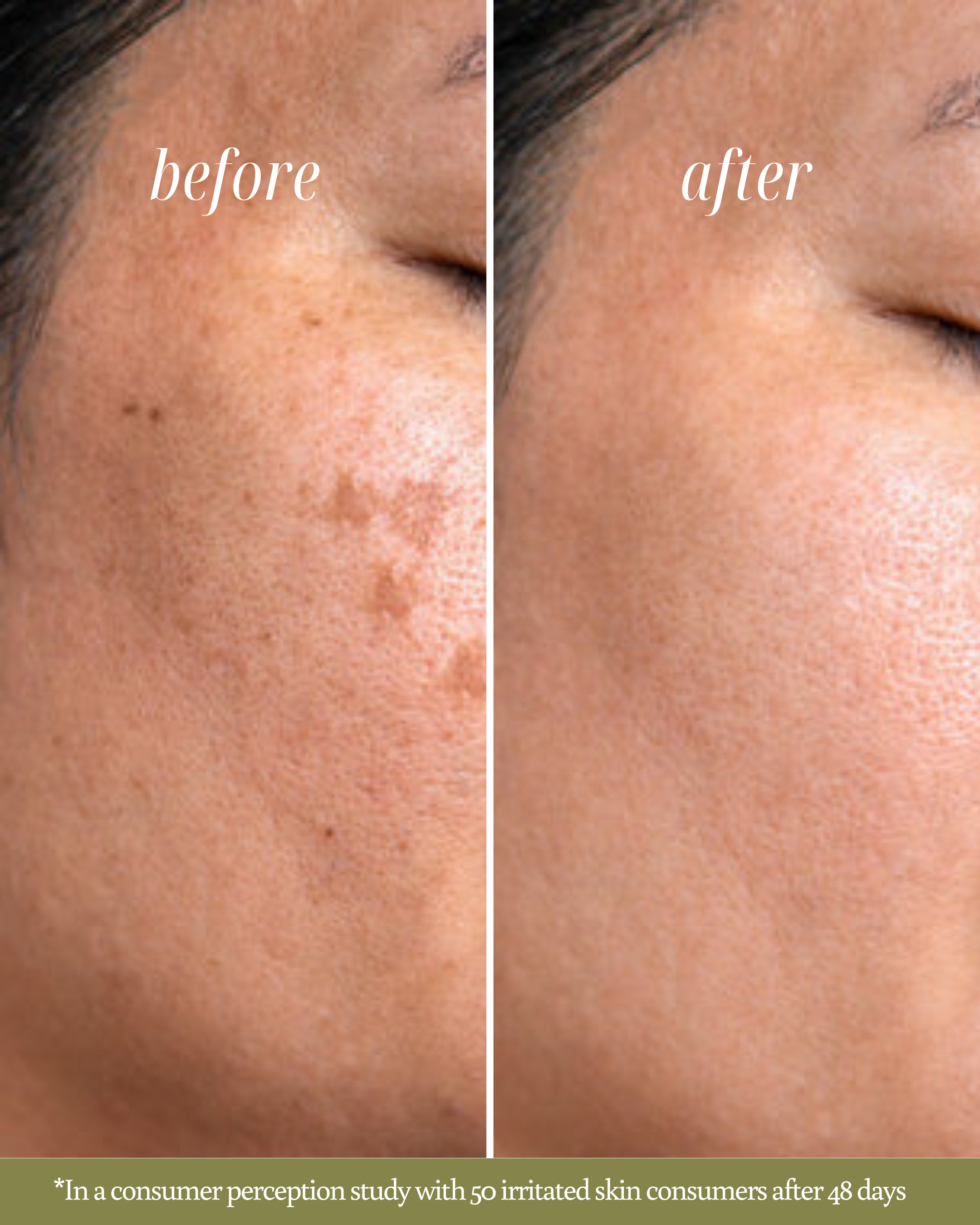 Before and after comparison of skin with visible improvement in face scars after using Rose Renewal Clay Mask in a consumer perception study.